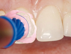 Entfernung von Zahnbelägen