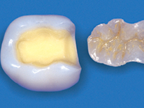 Vollkeramik Zahnarzt