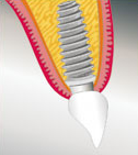 Zahnarzt Implantate